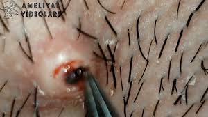 Kil Donmesi Boylesini Gormediniz Hair Rotation Blackheads Youtube