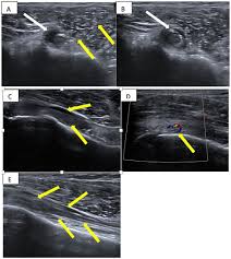 Image result for Biceps Tendon Injection