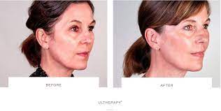 Dec 11, 2020 · simply wash your face, then attach the soft mask to your face before bed. How To Get Rid Of Jowls The Cosmetic Skin Clinic