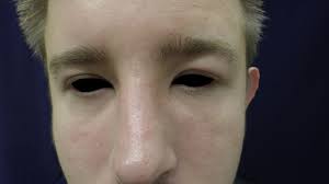 A case report of munchausen syndrome presenting with bleeding from ear. Successful Treatment Of Solid Persistent Facial Edema With Isotretinoin And Compression Therapy Jaad Case Reports