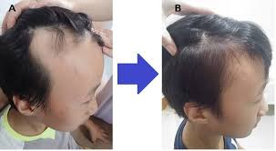 As with chinese herbs, the goal of acupuncture for hair loss is to correct imbalances or disharmonies that underlie changes in. A Patient Lee Kwon Acupuncture And Chiropractic Clinic Facebook