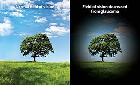 Health care professionals can help their patients understand these. What Is Glaucoma Weston Contact Lens Institute Weston Contact Lens Institute