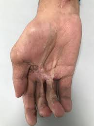 La Zetaplastia, también conocida como... - Dra Maria Cristina ...