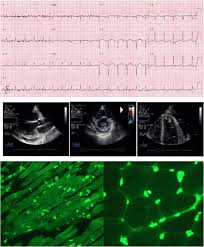 Here you find 16 meanings of the word myocarditis. Myocarditis A Clinical Overview Springerlink