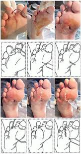 Image result for phlegmon of hand)