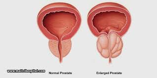 The Facts And Myths About Enlarged Prostates Maitri Hospital In 2021 Enlarged Prostate Benign Prostatic Hyperplasia Prostate Health Remedies