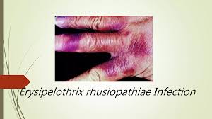 Image result for Erysipeloid
