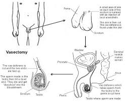 Image result for Vasectomy