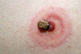 Bug Bite Black And Blue Ring 8 Common Bug Bites You Should Watch Out For Wes Moss