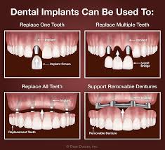 Patients who require multiple dental implants or supporting surgical procedures should wait for around two weeks before. Facebook