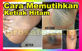 10 cara mudah bikin ketiak yang hitam jadi lebih cerah dan glowing. 4 Cara Memutihkan Ketiak Hitam Secara Alami Dan Permanen