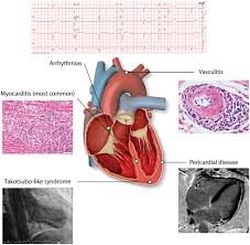 Although these categories extend the definition of myocarditis beyond the narrow. Cardiovascular Toxicities Associated With Immune Checkpoint Inhibitors Abstract Europe Pmc