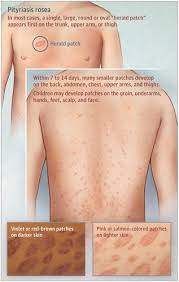 It is most common in people aged between 10 and 35 years. Pityriasis Rosea Jama Dermatology X Mol