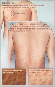 You can find oatmeal bath products at your pharmacy. Pityriasis Rosea Jama Dermatology X Mol