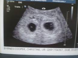 During this period women often visit doctors and complain about secretions. 4 Weeks Pregnant Baby Novocom Top