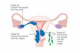 If you are diagnosed with recurrent uterine cancer, you may also want to consider participating in for how long? Womb Cancer Treating Womb Cancer
