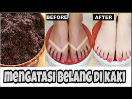 Cara Menghilangkan Belang Di Kaki Dan Mencerahkan Kaki Youtube