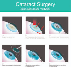 Image result for Cataract Extraction