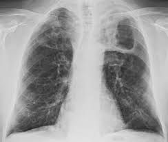 Tuberculosis a manual for medical students. File Tuberculosis Image1 Jpg Wikiversity