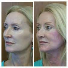 The area is numbed with a local anesthetic and as many as 18 sutures are used to hold the elevated tissue in place. My Threadlift Before And After Picture Beautiful And Subtle Brow Lift Jowls Lift Neck Lift Texture Around The Mouth And Mi Brow Lift Neck Lift Thread Lift