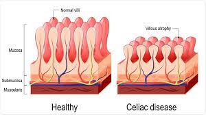 Taking a bite out of the controversy. Celiac Disease May Now Be Curable With Biodegradable Nanoparticles