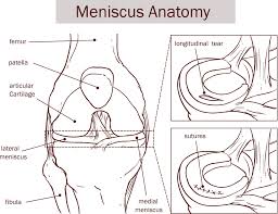 More serious meniscus tears may not heal on their own. Is An Acl Tear Worse Than A Meniscal Tear