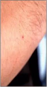 La maladie de lyme ou borréliose de lyme est une maladie infectieuse transmise par l'intermédiaire d'une piqûre de tique infectée. Maladie De Lyme Agence Regionale De Sante Auvergne Rhone Alpes