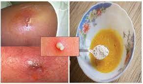 Bisul bisa sangat menjengkelkan karena bisa menimbulkan nyeri tak tertahankan. Petua Cara Merawat Bisul Yang Mudah Diamalkan