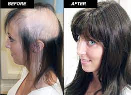 How much hair system costs is related to the base size. Non Surgical Hair Replacement Clinic Dubai Hair Replacement Hair Replacement Systems Hair System