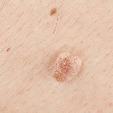 Skin Tag Removal in Dubai | Dynamic Life Clinics