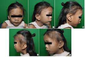 Image result for Webbed Neck