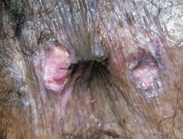 In the united states, it's estimated that doctors diagnose over 100,000 new skin cancer cases each year. Anal Cancer Images Dermnet Nz