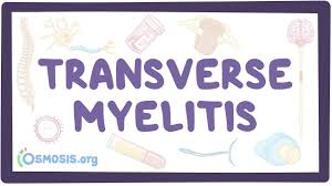 Nov 09, 2012 · associated problems dengue can occasionally affect several other body systems,. Transverse Myelitis Video Explanation Osmosis