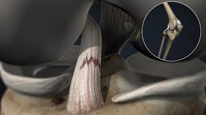 A grade 2 acl sprain is when the ligament is stretched beyond its capacity to the point it becomes loose. Acl Tears Oss Health