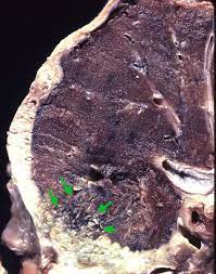 Malignant mesothelioma pathology pathology in outline format with mouse over histology previews. Yale Rosen Sur Twitter Peripheral Lung Adenocarcinoma Outlined By Arrows With Pleural Invasion And Extensive Spread Along Pleura Simulating Mesothelioma Pulmpath Gross Https T Co Rbl5g4pjim