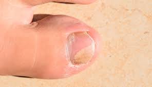 We found the best in the market! How To Tell If You Have A Toenail Fungus Colorado Center Of Orthopaedic Excellence