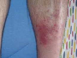 Spider and carpet beetles, booklice, cockroach nymphs, and fleas and ticks are the pests most often mistaken as bed bugs. Flea Vs Bed Bug Bites Identification Other Bites And What To Do Next