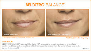 The juvéderm dermal filler treatment process is very quick (about 15 minutes) with immediate results. Fillers Belotero Restylane Juvederm Radiesse Dermatologist In Bethesda Md