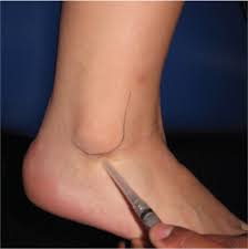Heel Pain Diagnosis And Management American Family Physician
