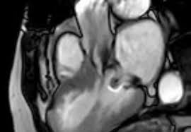 Image result for Left Ventricular Outflow Obstruction