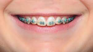 Each color scheme contains the html color codes you will need when coding your website template. Colored Braces And Bands Murray Orthodontics