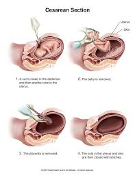 Ini boleh jadi serius, bergantung kepada di mana pembekuan itu berlaku. Antara Bersalin Normal Vs Caesar Yang Mana Lagi Sakit