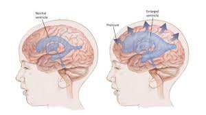 Image result for Hydrocephalus