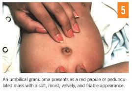 Image result for Umbilicus botryoides