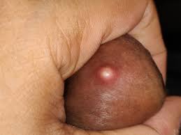 Ingrown hairs cause red, often itchy bumps where a hair has grown back into the skin. Pimple Ingrown Hair What Is This On My Penile Shaft Penis Disorders Forums Patient