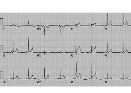 Complications may include heart failure due to dilated cardiomyopathy or cardiac arrest. Desafios De Ecg Descomplicando Ecg