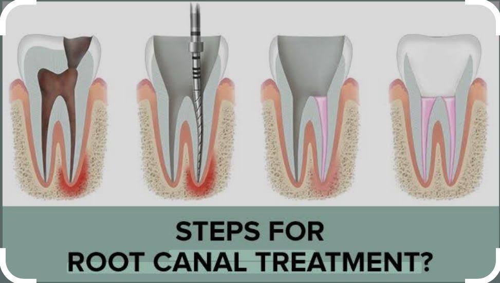 ROOT CANAL TREATMENT (RCT) product image