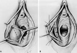 The bartholin's glands are however, when the cyst gets larger, you might be able to feel a lump close to the vaginal opening. Bartholin S Cyst Abscess Clinical Features Management Teachmeobgyn