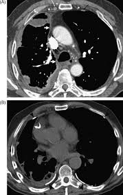 Check spelling or type a new query. References In Malignant Pleural Mesothelioma Computed Tomography And Correlation With Histology European Journal Of Radiology