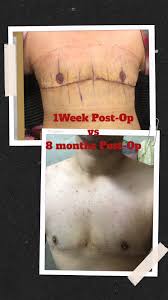 Check spelling or type a new query. Transgender Surgery Before And After Photos Neda Transgender Surgery